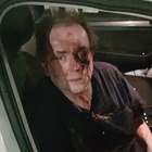Tassista massacrato di botte da un passeggero: «Pensavo di morire»