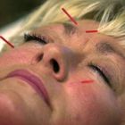 Menopausa, l'agopuntura valida alternativa alla terapia ormonale