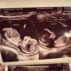 Mamma nata con due uteri rimane incinta in entrambi contemporaneamente: ora aspetta due gemelle. Il caso rarissimo