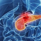 Tumore al pancreas, diagnosi possibile 
