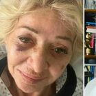 Enrica Bonaccorti, paura per una caduta dalle scale: «Non mi ha menata nessuno». Cosa è successo
