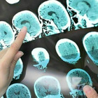Influenza, ricerca trova un legame con malattie neurogenerative: «Rischio elevato di avere Alzheimer o Parkinson»