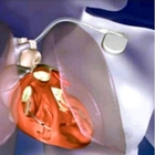 Smartphone a rischio chi ha un pacemaker o defibrillatore impiantabile