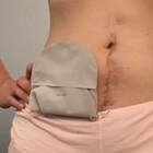 Cos'è l'ileostomia: porterà un 'sacchetto'