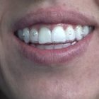 Con l'Ortodonzia Invisibile un bel sorriso è per tutti: addio agli apparecchi antiestetici
