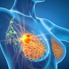 Tumore seno, cura riduce del 25% il rischio di recidive