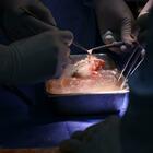 Trapianto di rene di maiale su un paziente in vita