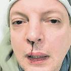 Dado, l'ex comico di Zelig picchiato dallo stalker 17enne della figlia: «Mi ha rotto il naso»