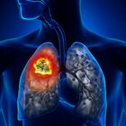 Tumore al polmone e l'inquinamento