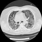 Venti polmoniti intestiziali in un giorno a Latina, ecco cosa vedono i radiologi
